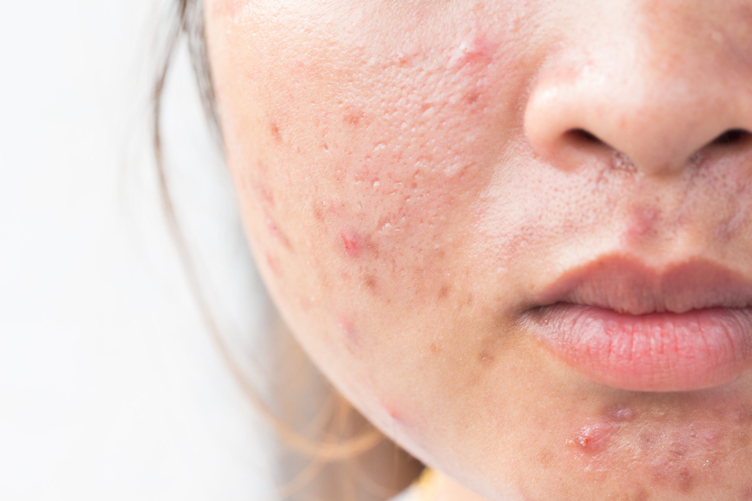 acne after birth control